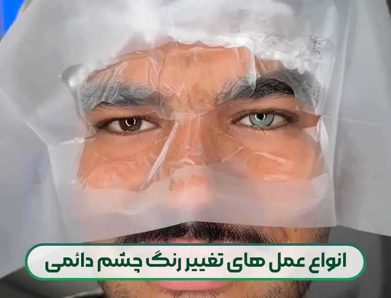 عمل تغییر رنگ چشم + معرفی 3 روش