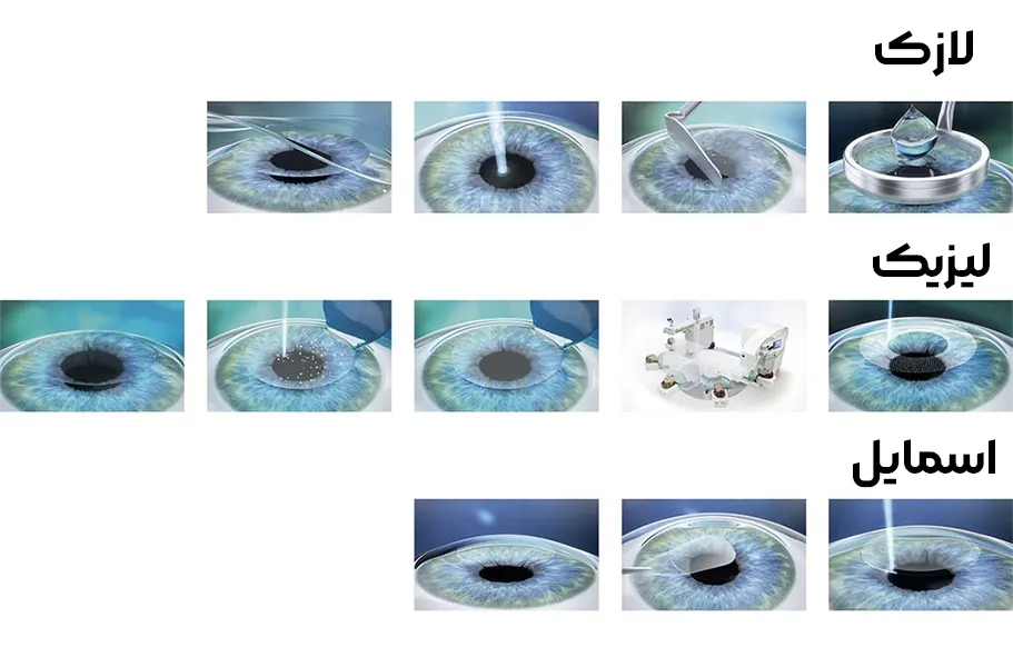 مقایسه عمل لیزیک و لازک (prk) و اسمایل