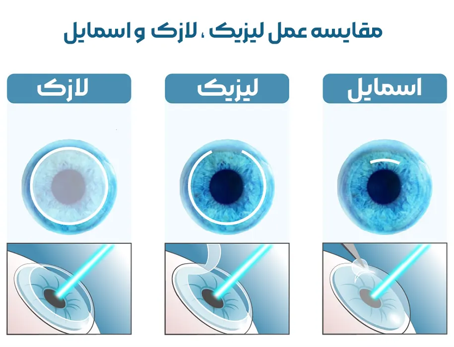 مقایسه عمل لیزیک و لازک (prk) و اسمایل