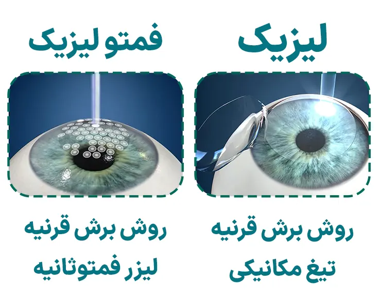 تفاوت لیزیک و فمتولیزیک