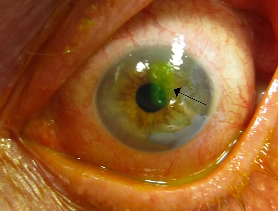 پارگی قرنیه