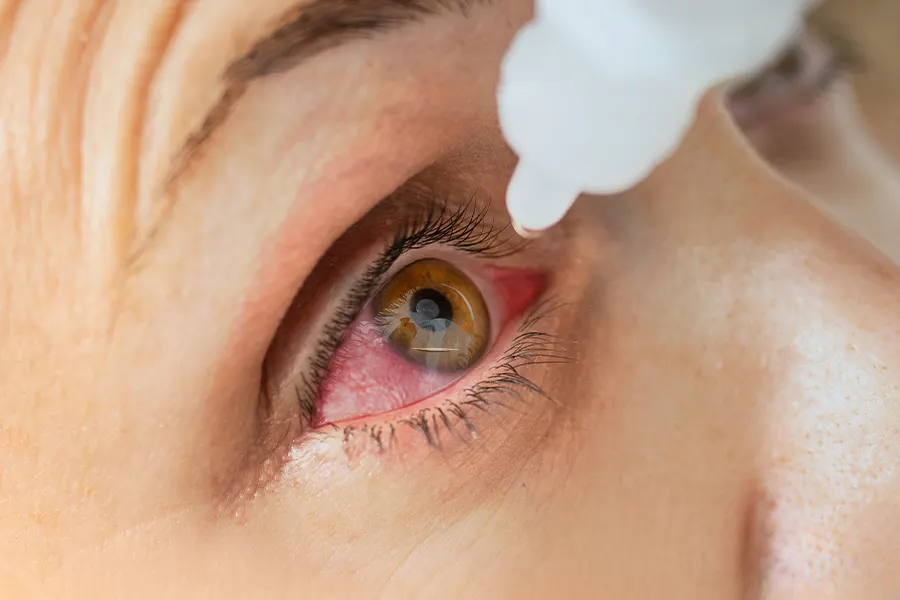 درمان پارگی قرنیه چشم