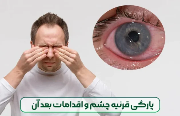 پارگی قرنیه چشم و اقدامات بعد آن