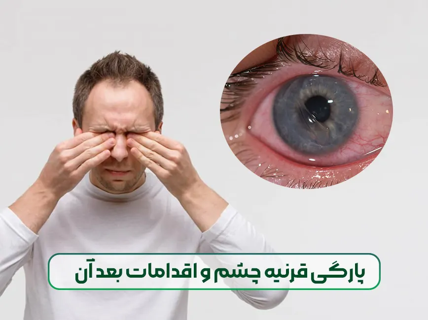 پارگی قرنیه چشم و اقدامات بعد آن
