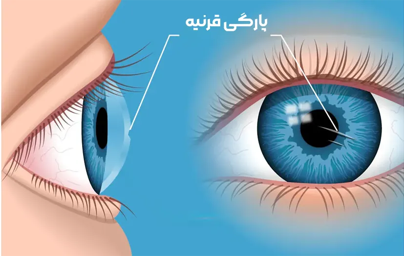 پارگی قرنیه