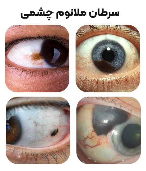 ملانوم چشمی