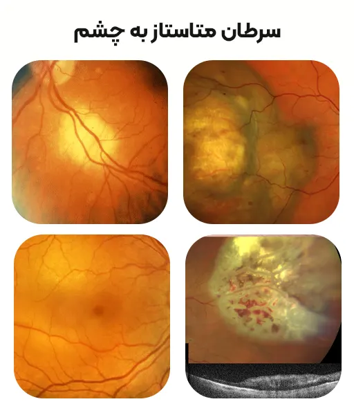 سرطان متاستاز به چشم