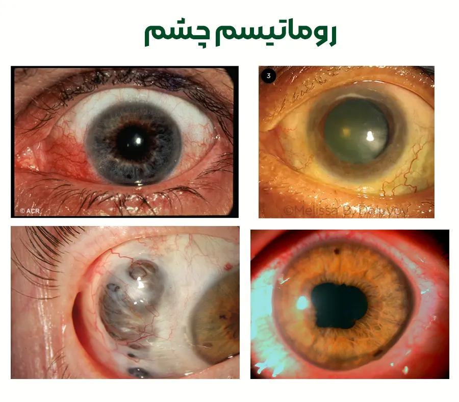 روماتیسم چشم