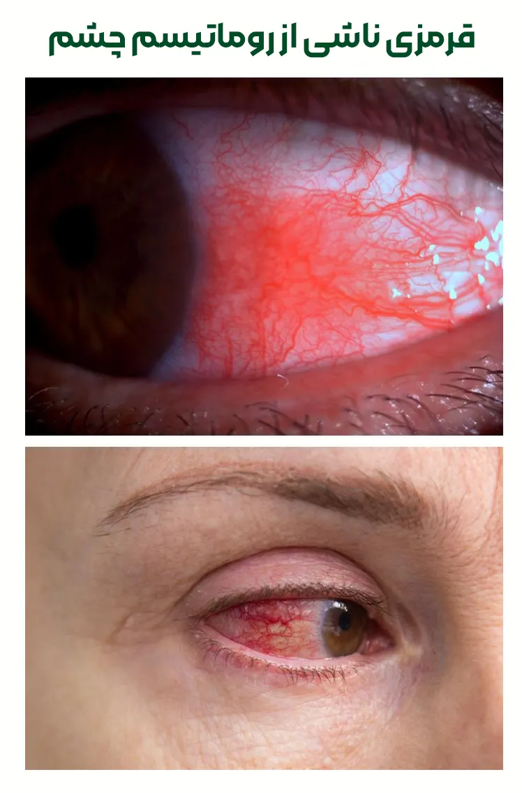 قرمزی ناشی از روماتیسم چشم