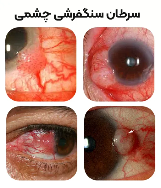 کارسینوم سلول سنگفرشی چشم