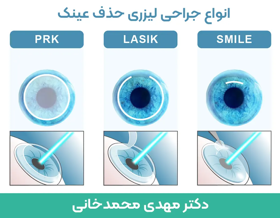 لیزیک لازک اسمایل