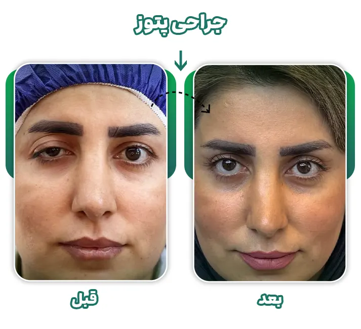 قبل و بعد جراحی پتوز