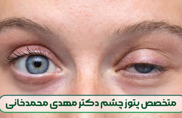 متخصص پتوز چشم دکتر مهدی محمدخانی