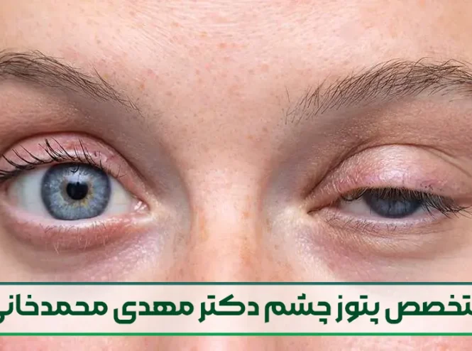 متخصص پتوز چشم دکتر مهدی محمدخانی