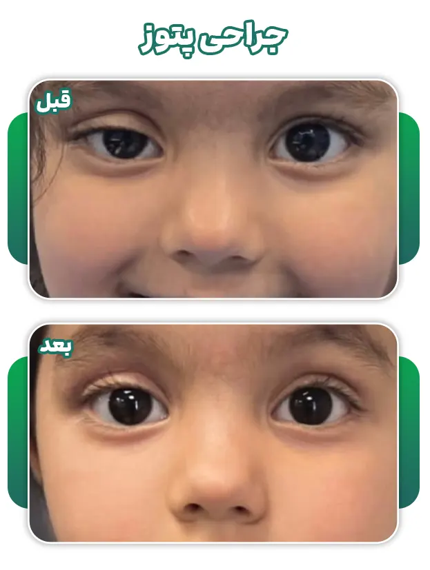 جراحی پتوز چشم