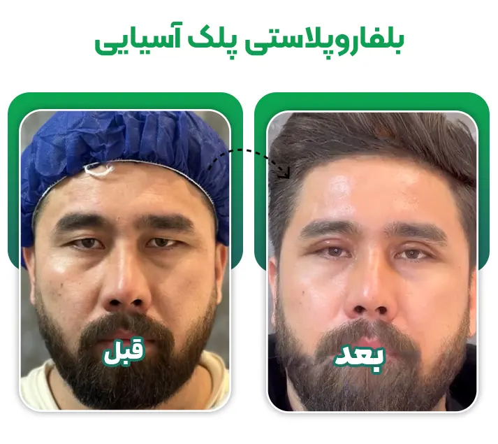 جراحی بلفاروپلاستی پلک آسیایی