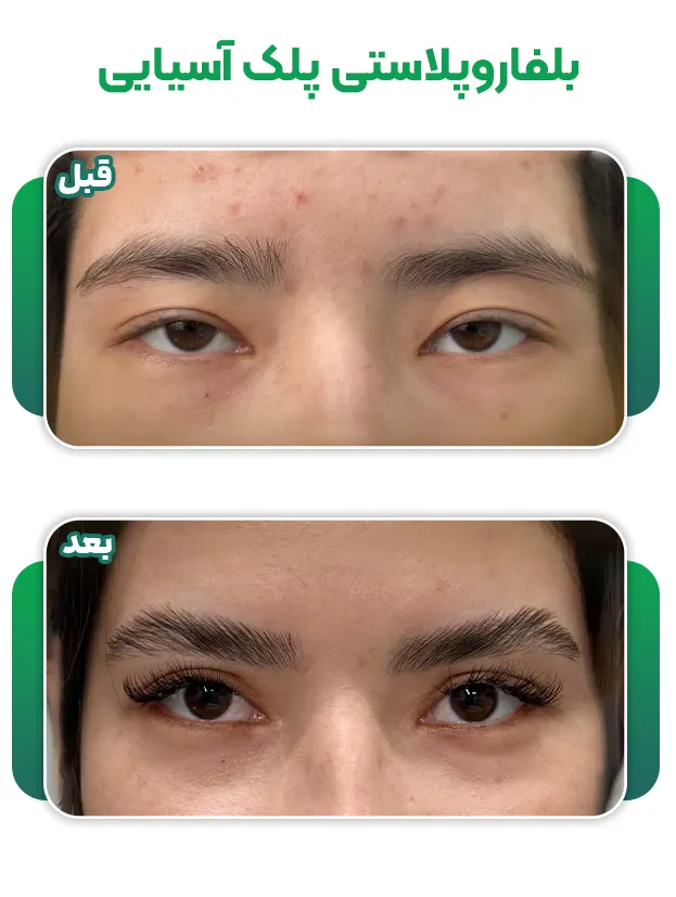 جراحی بلفاروپلاستی پلک آسیایی