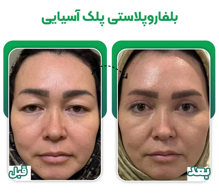 جراحی بلفاروپلاستی پلک آسیایی