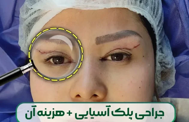 جراحی بلفاروپلاستی پلک آسیایی