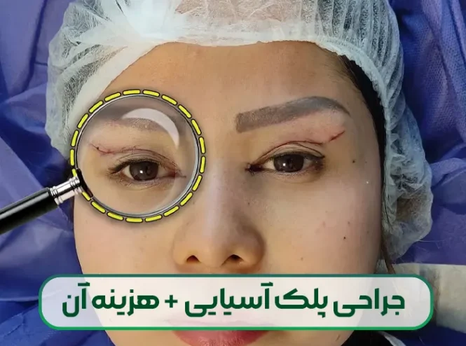جراحی بلفاروپلاستی پلک آسیایی