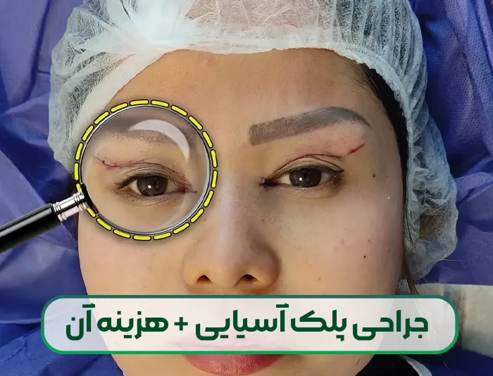 جراحی بلفاروپلاستی پلک آسیایی