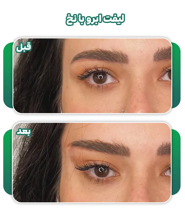 لیفت ابرو با نخ