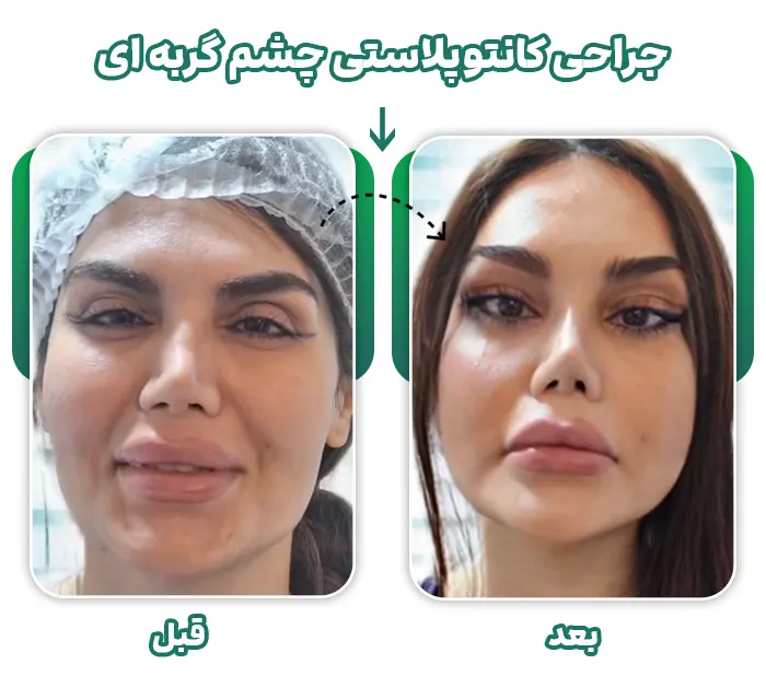 کانتوپلاستی