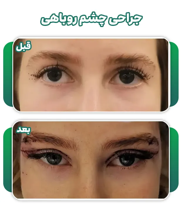 عمل چشم روباهی