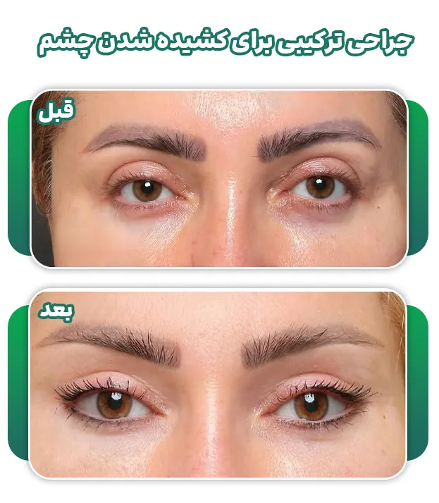 جراحی کشیده کردن چشم