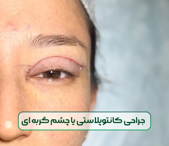 کانتوپلاستی