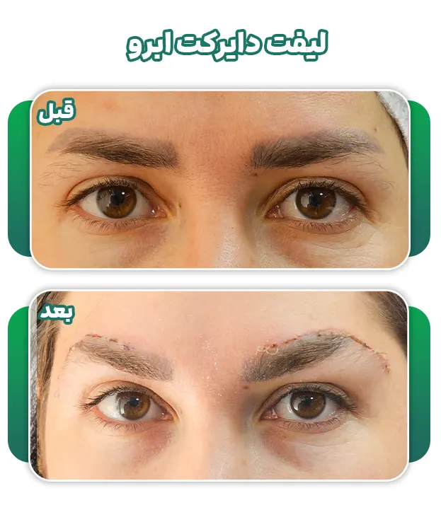 لیفت دایرکت ابرو