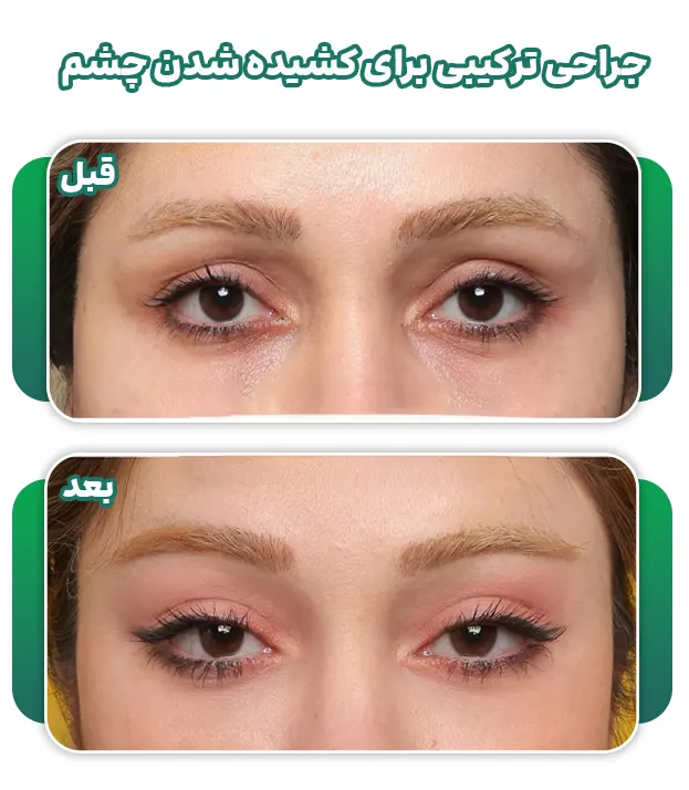 جراحی کشیده شدن چشم