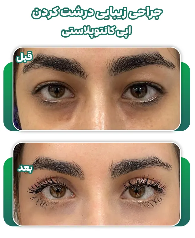 اپی کانتوپلاستی