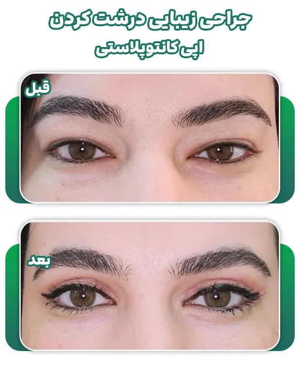 جراحی زیبایی درشت کردن چشم