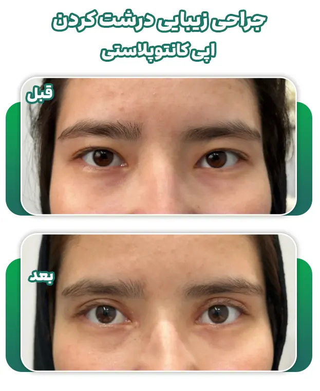 اپی کانتوپلاستی