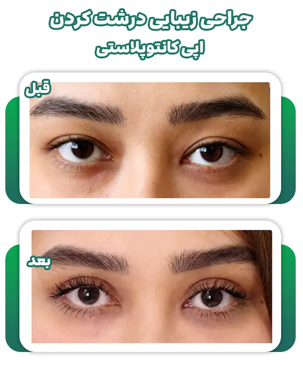 جراحی زیبایی درشت کردن چشم
