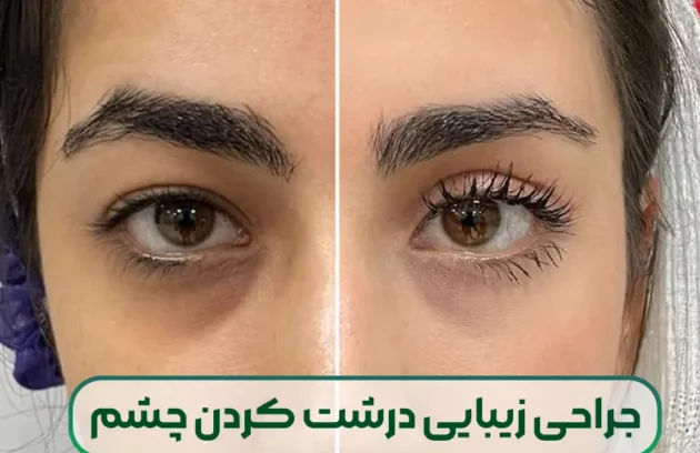 جراحی زیبایی درشت کردن چشم