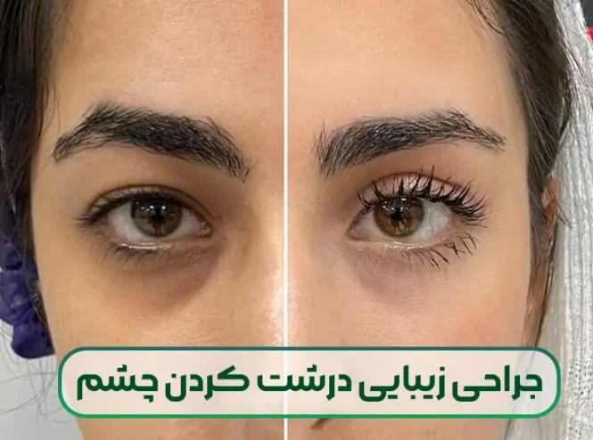 جراحی زیبایی درشت کردن چشم