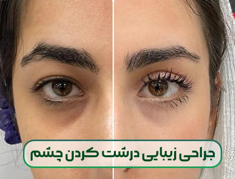 جراحی زیبایی درشت کردن چشم