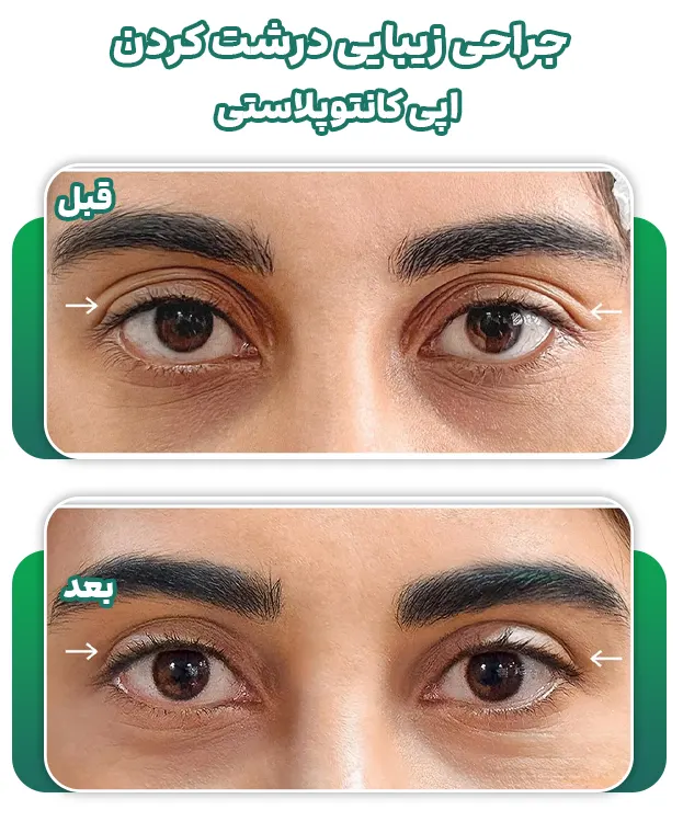 جراحی زیبایی درشت کردن چشم