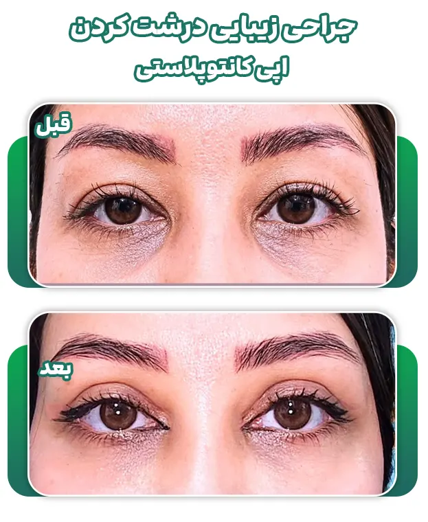 اپی کانتوپلاستی