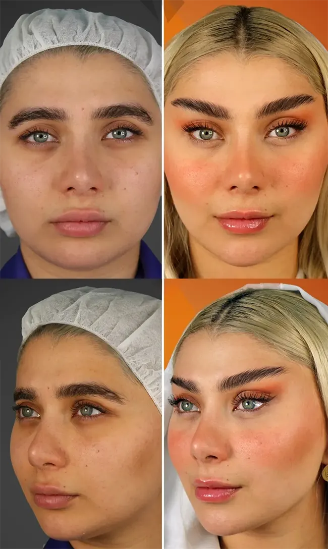 لیفت ابرو و شقیقه