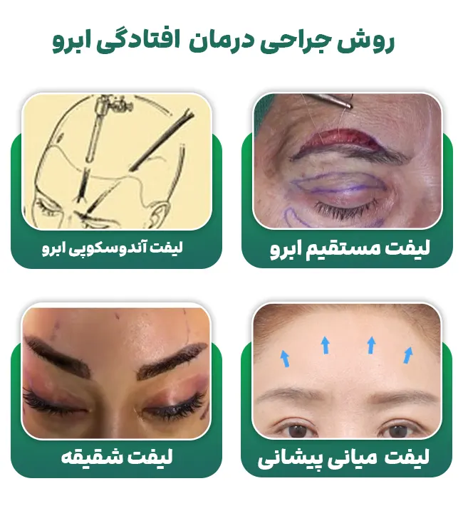 روش های جراحی درمان افتادگی ابرو