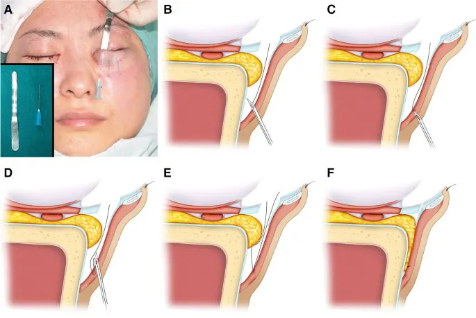 تنظیم چربی زیر چشم در جراحی بلفارو پایین