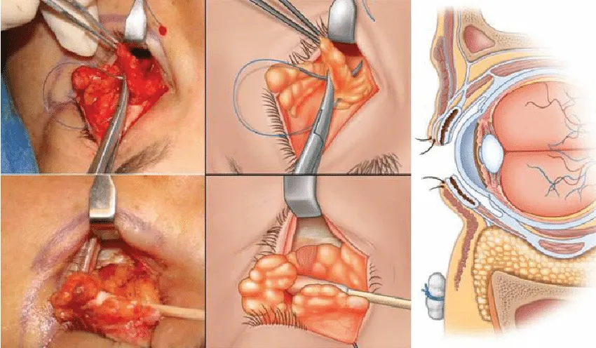 جا به جای چربی زیر چشم در جراحی پلک پایین
