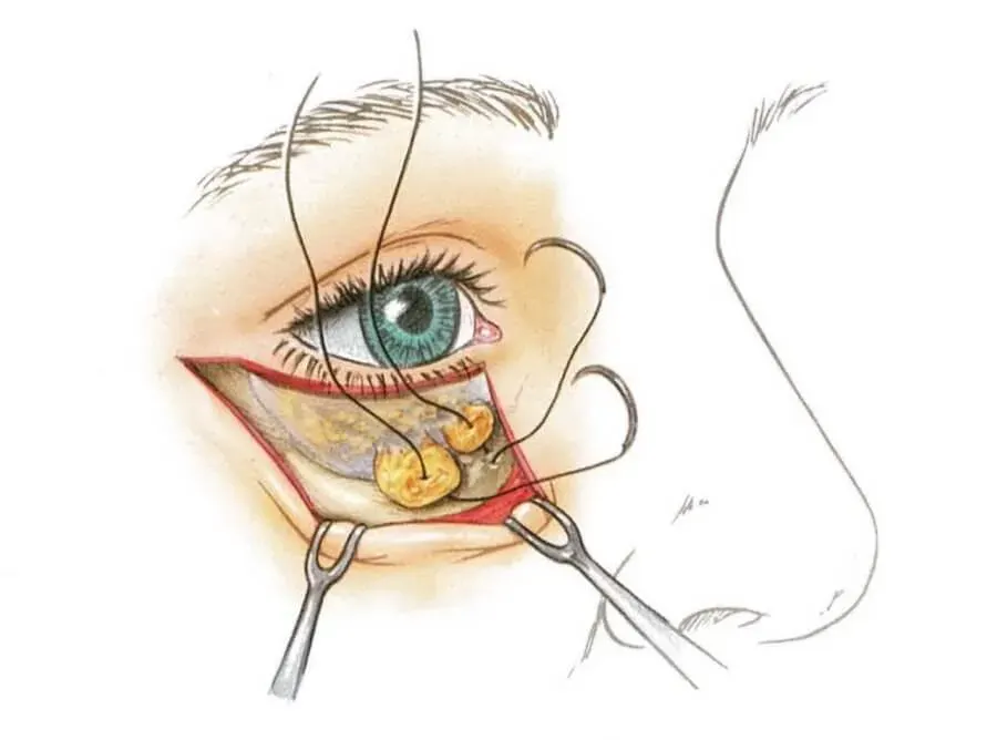 فیکس چربی زیر چشم در جراحی پلک پایین