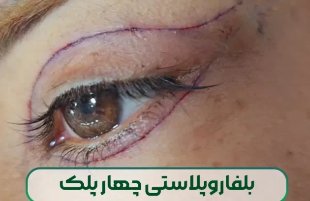 بلفاروپلاستی چهار پلک
