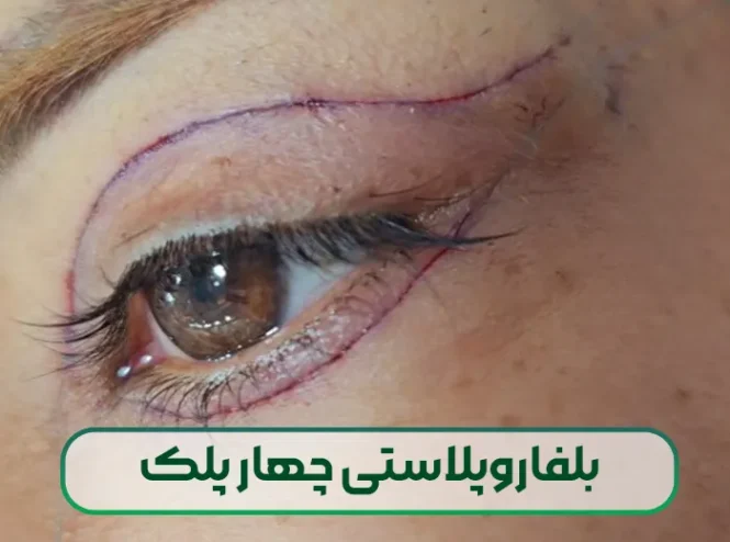 بلفاروپلاستی چهار پلک