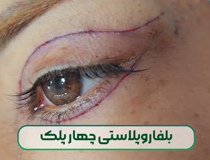 بلفاروپلاستی چهار پلک