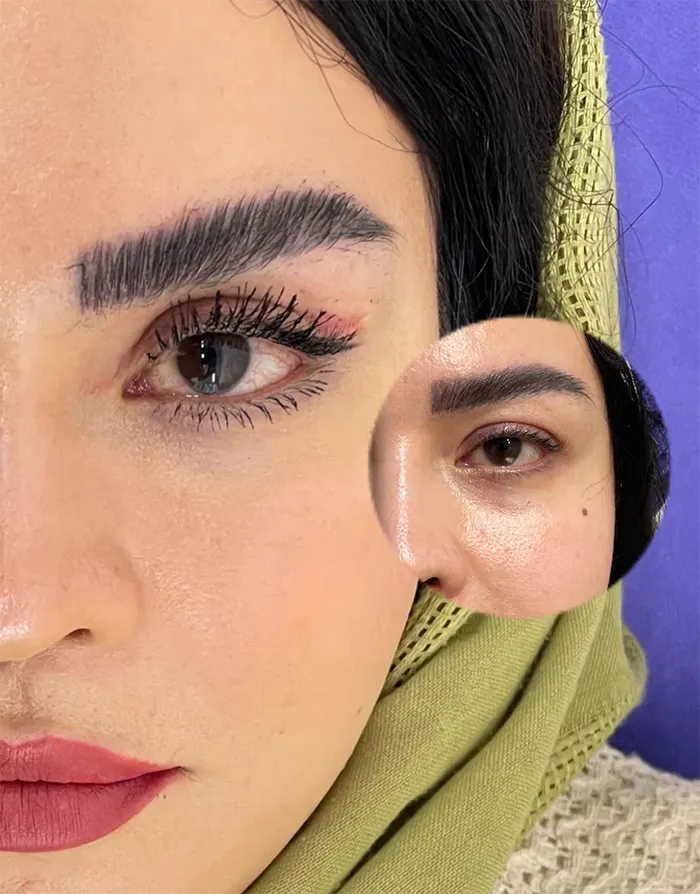 عمل چشم روباهی